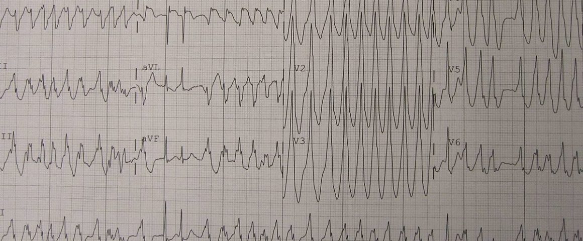 Herz-Kammerflimmern, EKG