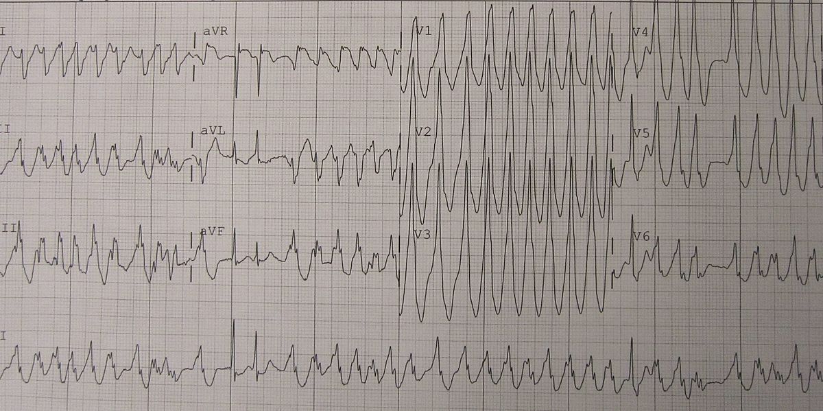 Herz-Kammerflimmern, EKG